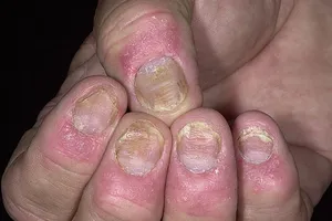 Bệnh nhân vảy nến cần tránh xa lang băm