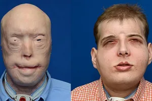 Ca ghép mặt phức tạp nhất thế giới đã thành công