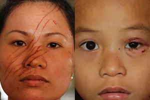 Hai mẹ con bị hàng xóm rạch nát mặt