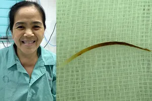 Hóc xương cá năm tháng mới phát hiện