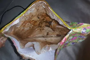 Túi sưởi ấm phát nổ, bé gái 17 tháng tuổi bị bỏng