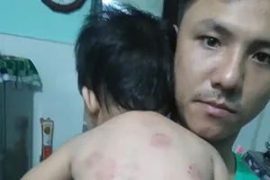 Ngày đầu đi học, bé 13 tháng bị bạn cắn tím lưng