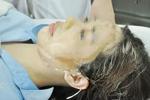 Nữ sinh bị tạt acid có thể hỏng mắt