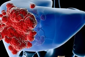 Một nửa số người ung thư gan hết khả năng điều trị