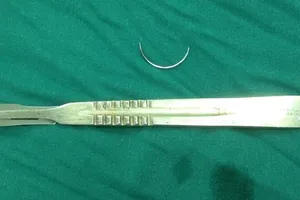 Lấy cây kim nằm trong bụng bệnh nhân suốt 15 năm