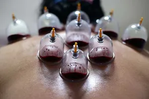 Giác hơi Trung Quốc ‘gây bão’ tại Olympic Rio