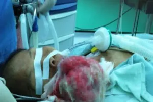 Cắt khối u hơn 1 kg trên mặt bệnh nhân 53 tuổi