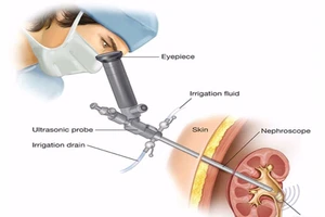 Áp dụng thành công phương pháp lấy sỏi thận qua da