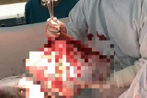 Bóc tách thành công khối u buồng trứng khổng lồ 