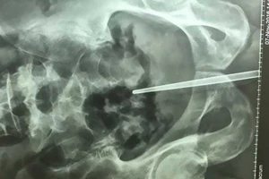 Chơi dại nhét đũa vào dương vật