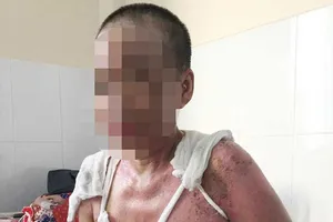 Đi phụ quán cơm, bị tạt nước sôi bỏng nặng 