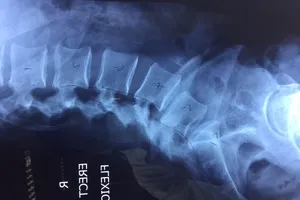 Nắn trượt cột sống cho bệnh nhân bằng robot