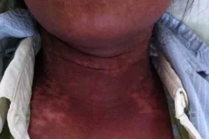 Chớ coi thường dị ứng thuốc 