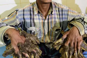 ‘Người cây’ đã trở lại bình thường