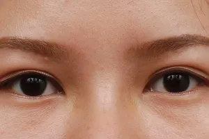 Đủ thứ mối nguy khi mắt ‘biểu tình’