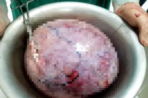 Bụng như mang thai 8 tháng, đi khám 'ra' khối u 5,5kg