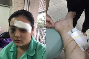 Cô gái 16 tuổi bị đánh có khả năng hỏng 1 mắt
