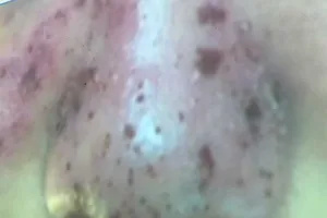 Liều mạng đi thẩm mỹ, mặt chi chít 'hố bom'