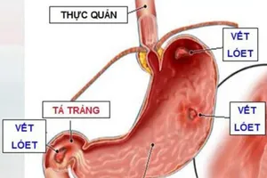 Thuốc nào gây hại dạ dày?