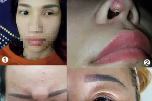 Làm đẹp ‘chui’: Muôn vàn tai biến khóc cười