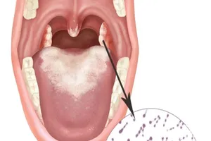 Bệnh bạch hầu bất ngờ xuất hiện trở lại ở Kon Tum