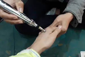 Chóng mặt, đau cơ vì ‘bút thần’ dò huyệt
