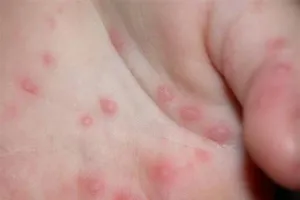 Miền Trung phát hiện thêm nhiều ổ dịch tay-chân-miệng