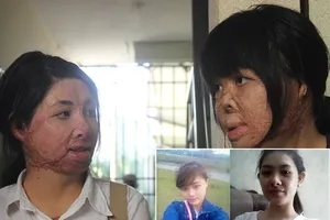 2 cô gái bị chồng đốt tựa vào nhau tìm lại hình hài