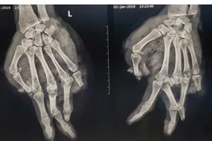 Bầm dập, lóc da tay vì thay bình gas khi ăn lẩu