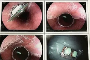 Suýt nguy kịch vì uống thuốc còn nguyên vỏ