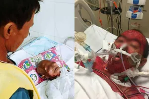 Suy thận nặng, hoại tử sau khi uống thuốc cảm sốt