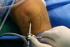 Chơi bóng rổ té, tự uống thuốc giảm đau, phải phẫu thuật