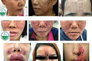 Tàn phá dung nhan vì tiêm, cấy chất trẻ hóa da