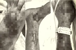 Cảnh giác với ‘vi khuẩn ăn thịt người’ đa chủng loại