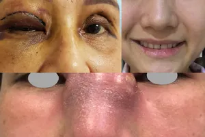 Tởn tới già sau một lần làm đẹp