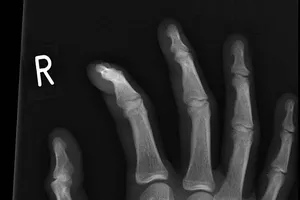 Nhập viện phẫu thuật vì răng 'chui vào' tay