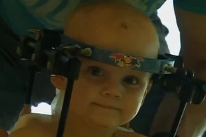 Phẫu thuật ghép đầu thành công cho bé trai một tuổi