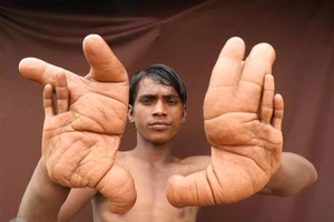 Nỗi khổ của cậu bé có 'đôi bàn tay quỷ'