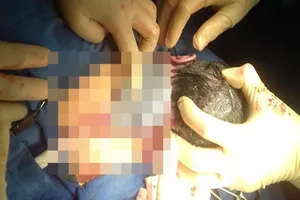 Bé gái Quảng Nam chào đời với 4 vòng dây rốn quấn cổ