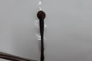 Chảy máu mũi 10 ngày, đến BV được bác sĩ gắp ra con đỉa