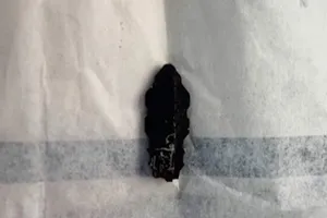 Các bác sĩ đã lấy ra một phần chìa khoá đã gãy màu đen. Ảnh: BV