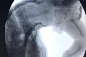 Quảng Nam: Bé sơ sinh bị gãy xương đùi khi sinh mổ