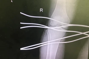 Thanh niên bị 5 thanh sắt đâm xuyên chân 