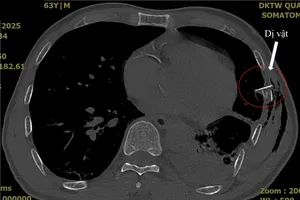 Bệnh nhân gặp tai nạn, bị xương sườn đâm thủng phổi