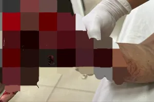 Bé trai 12 tuổi dập nát 2 bàn tay nghi do pháo nổ