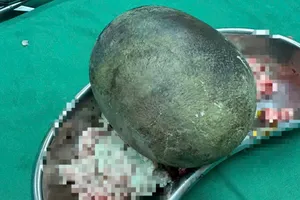 Sỏi bàng quang to như quả bóng trong cơ thể người đàn ông 45 tuổi