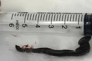 Đi bắt cá ở suối, người phụ nữ bị con vắt chui vào mũi