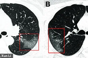 Thấy gì trong ảnh phổi của một bệnh nhân nhiễm virus Corona?