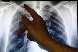 WHO báo động tử vong do bệnh lao tăng trở lại trên toàn cầu do COVID-19