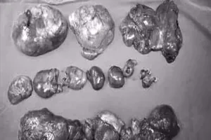 Tưởng béo bụng ai ngờ mang trong mình 20 u mỡ